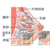 得了乳腺纤维瘤不能吃什么